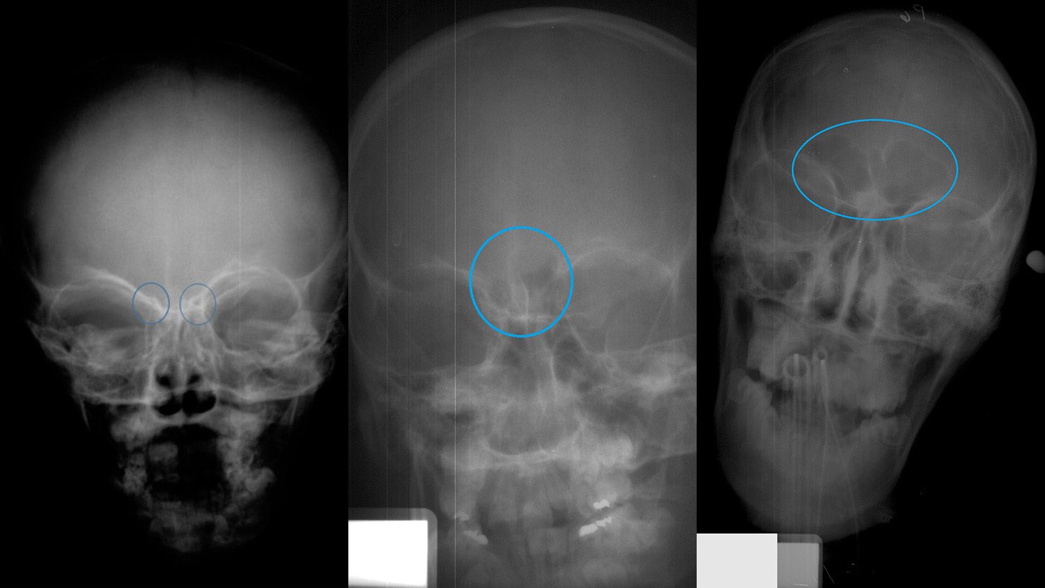 frontal sinus x-ray